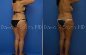 Thigh Lift Before and After | Sayah Institute