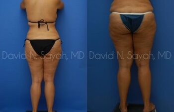 Thigh Lift Before and After | Sayah Institute