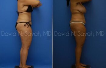 Thigh Lift Before and After | Sayah Institute