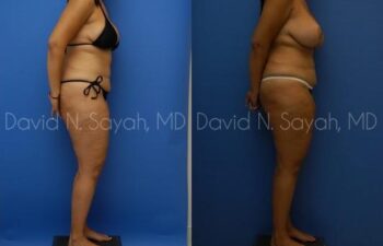Thigh Lift Before and After | Sayah Institute