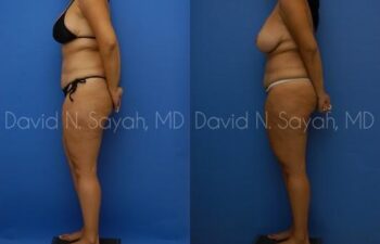 Thigh Lift Before and After | Sayah Institute