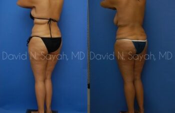 Thigh Lift Before and After | Sayah Institute