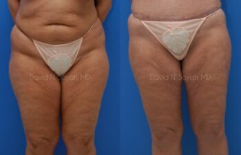 Liposuction Before and After | Sayah Institute