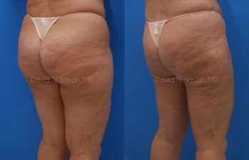 Liposuction Before and After | Sayah Institute