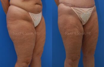 Liposuction Before and After | Sayah Institute