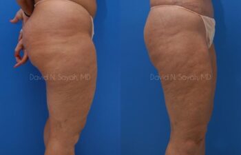 Liposuction Before and After | Sayah Institute