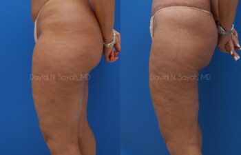 Liposuction Before and After | Sayah Institute
