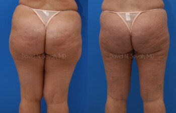 Liposuction Before and After | Sayah Institute