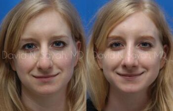 Rhinoplasty Before and After | Sayah Institute