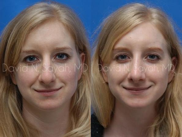 Rhinoplasty Before and After | Sayah Institute