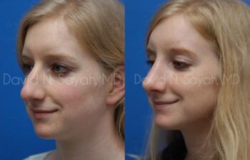 Rhinoplasty Before and After | Sayah Institute
