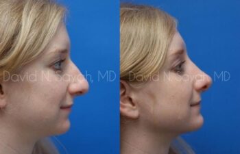 Rhinoplasty Before and After | Sayah Institute