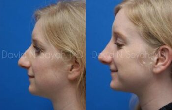 Rhinoplasty Before and After | Sayah Institute