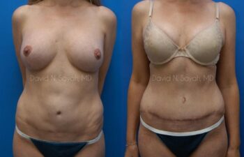 Tummy Tuck Before and After | Sayah Institute