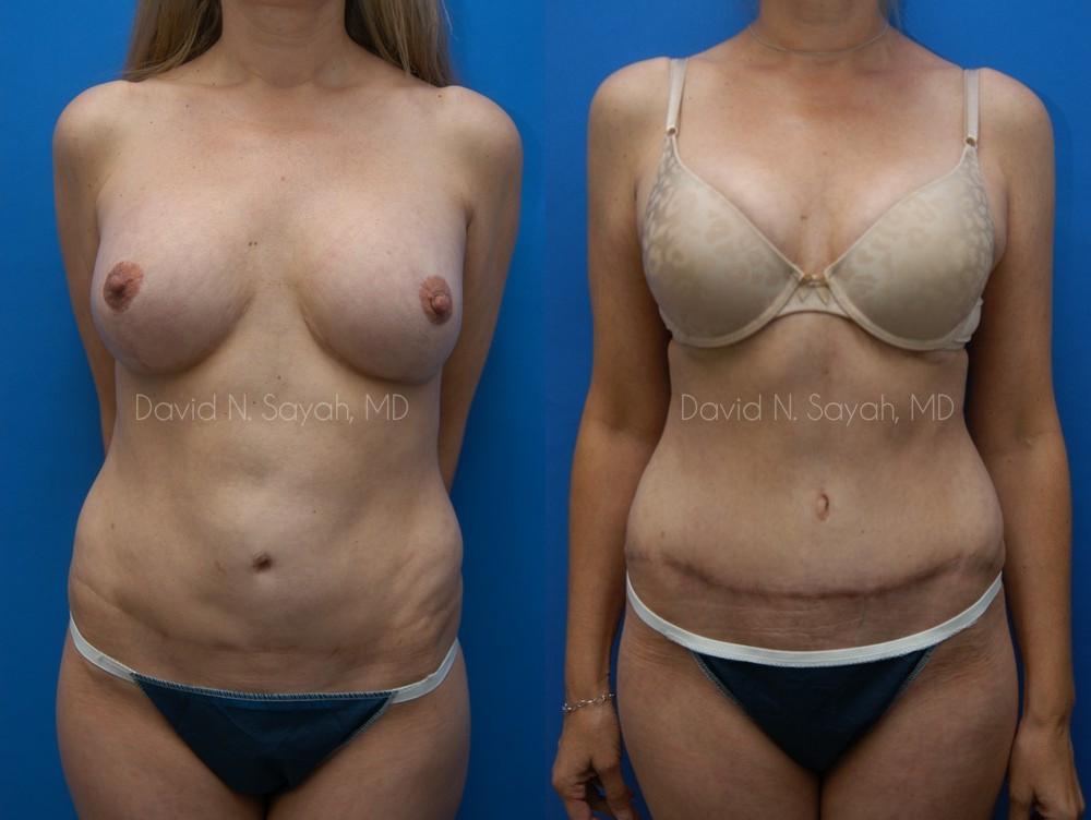 Tummy Tuck Before and After | Sayah Institute
