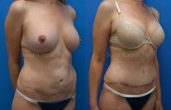 Tummy Tuck Before and After | Sayah Institute