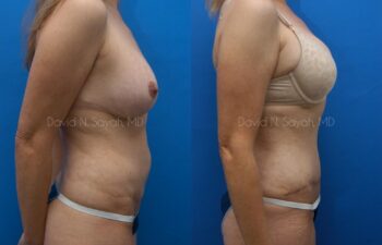 Tummy Tuck Before and After | Sayah Institute