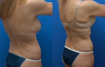 Tummy Tuck Before and After | Sayah Institute