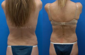 Tummy Tuck Before and After | Sayah Institute
