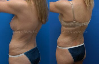 Tummy Tuck Before and After | Sayah Institute