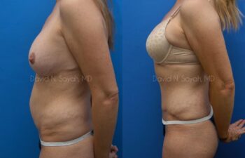 Tummy Tuck Before and After | Sayah Institute