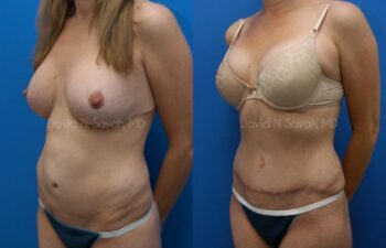 Tummy Tuck Before and After | Sayah Institute