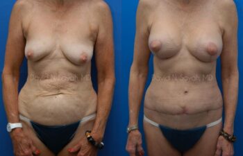 Body Lift Before and After | Sayah Institute