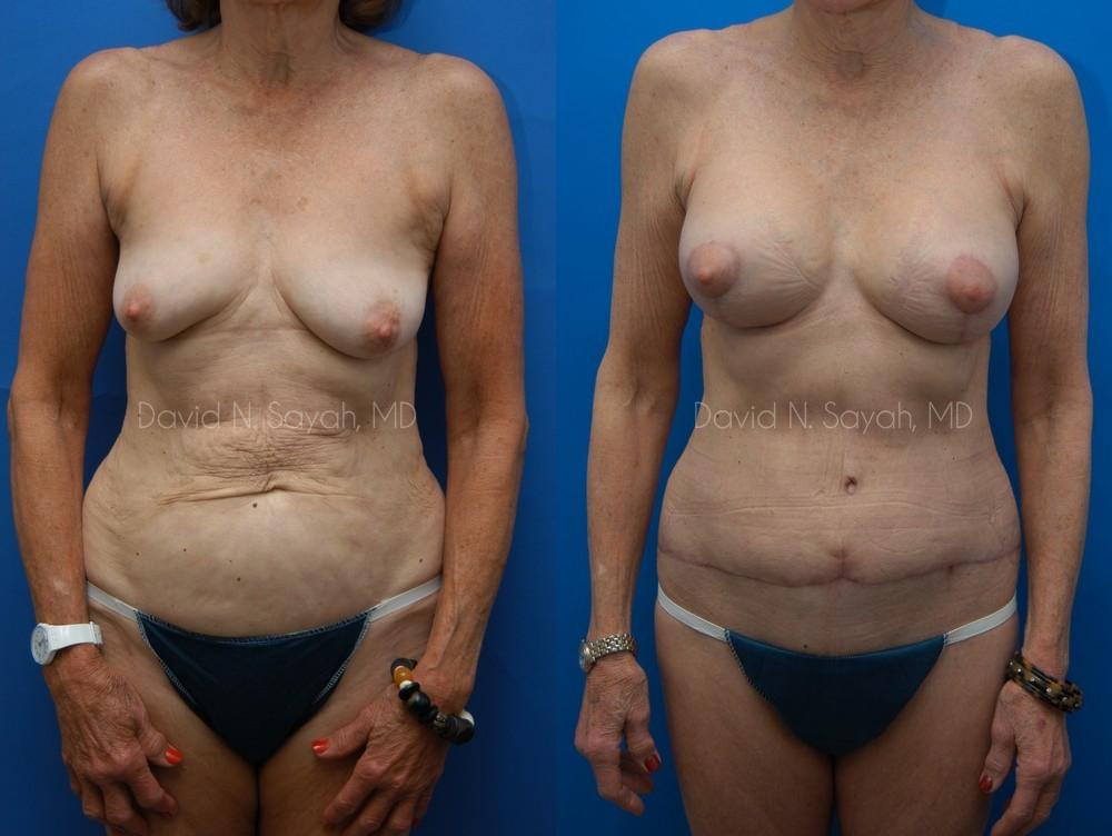 Body Lift Before and After | Sayah Institute