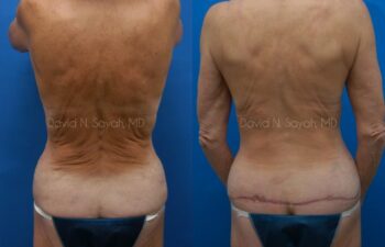 Body Lift Before and After | Sayah Institute