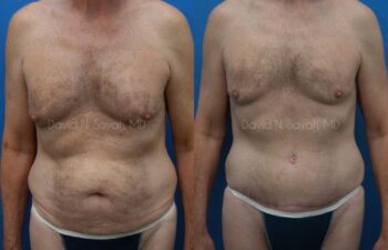Tummy Tuck Before and After | Sayah Institute