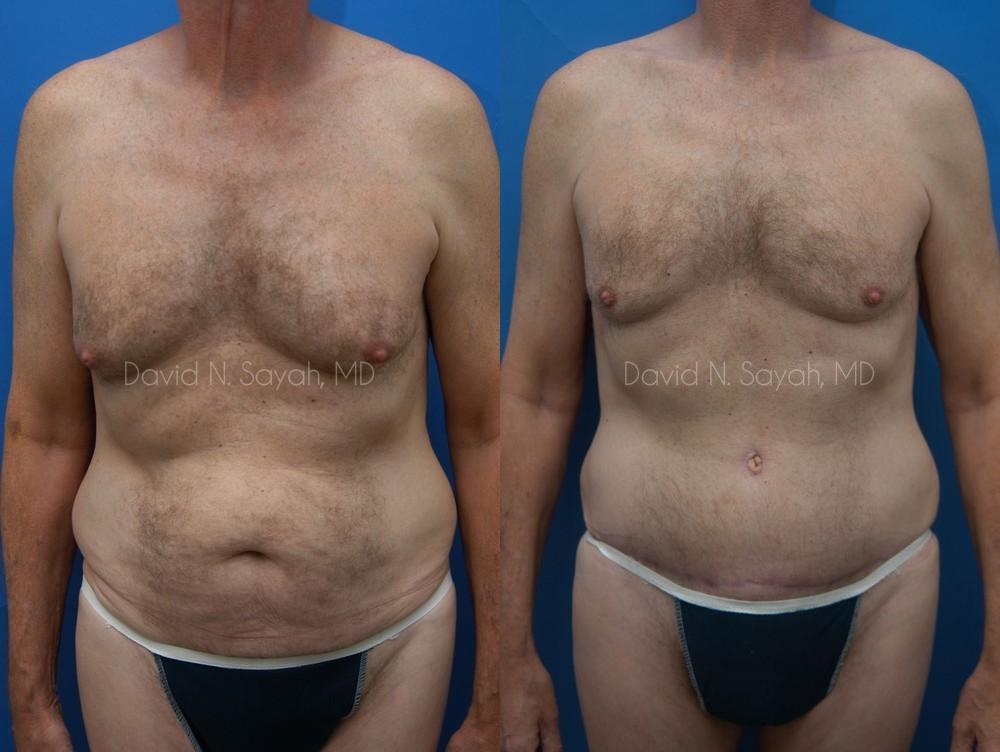 Tummy Tuck Before and After | Sayah Institute