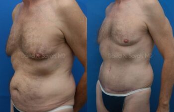 Tummy Tuck Before and After | Sayah Institute