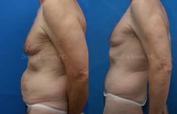 Tummy Tuck Before and After | Sayah Institute