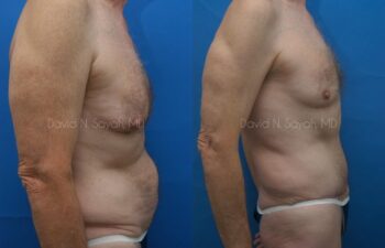 Tummy Tuck Before and After | Sayah Institute