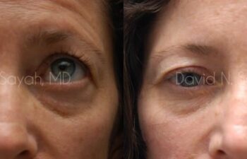 Eyelid Surgery Before and After | Sayah Institute