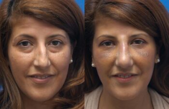 Eyelid Surgery Before and After | Sayah Institute