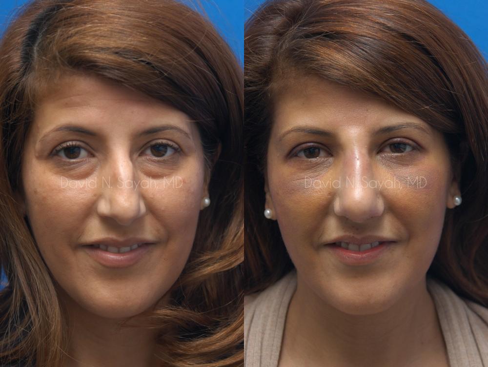 Eyelid Surgery Before and After | Sayah Institute