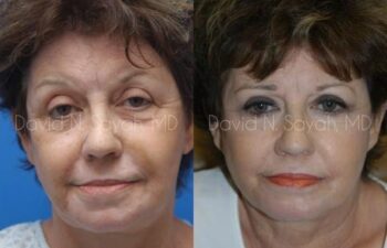Eyelid Surgery Before and After | Sayah Institute