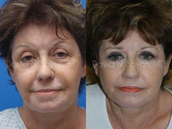 Eyelid Surgery Before and After | Sayah Institute
