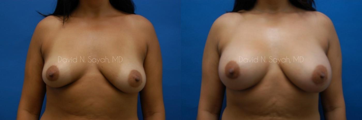 Breast Augmentation Before and After | Sayah Institute