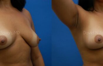 Breast Augmentation Before and After | Sayah Institute