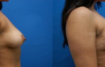 Breast Augmentation Before and After | Sayah Institute