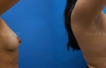 Breast Augmentation Before and After | Sayah Institute