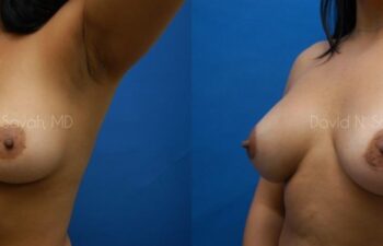 Breast Augmentation Before and After | Sayah Institute