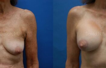 Breast Augmentation And Mastopexy Before and After | Sayah Institute