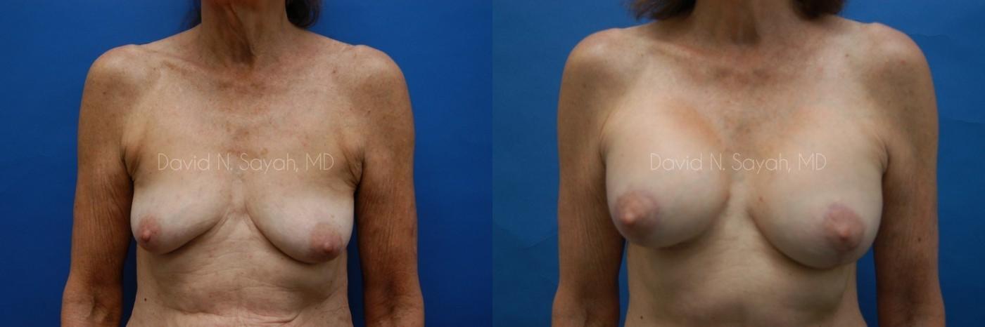 Breast Augmentation And Mastopexy Before and After | Sayah Institute