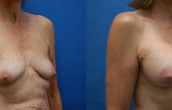 Breast Augmentation And Mastopexy Before and After | Sayah Institute