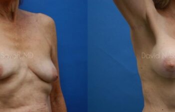Breast Augmentation And Mastopexy Before and After | Sayah Institute