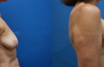 Breast Augmentation And Mastopexy Before and After | Sayah Institute