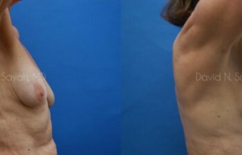 Breast Augmentation And Mastopexy Before and After | Sayah Institute